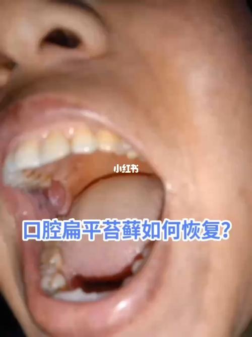 口腔扁平苔藓能治好吗?_口腔_调节内分泌_内分泌_中医