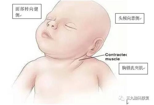 斜颈是一个症状,而不是一个诊断,临床表现为因为颈部的问题导致头向