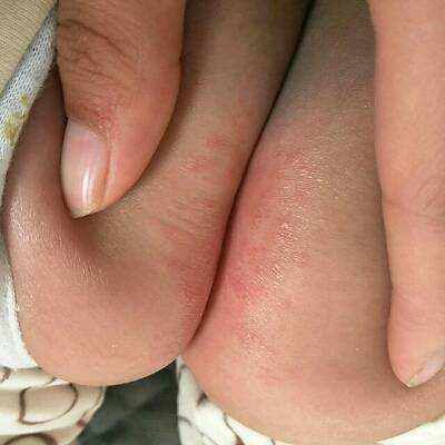 宝宝反复红屁股,家长看了都心疼!月嫂这么做能帮上大忙!