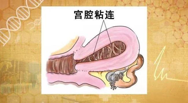 试管婴儿检查发现宫腔粘连应该怎么办如何治疗