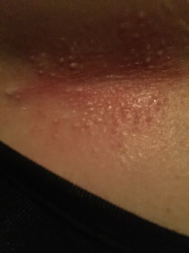 肚子皮肤突然长这样的痘痘,周围很红,有白色的小点点,又痒又痛 到底是