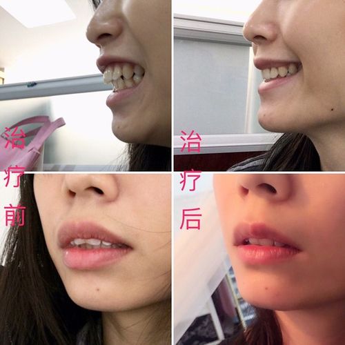 龅牙分为齿性和骨性,但大多数人并不知道自己属于哪种情况.