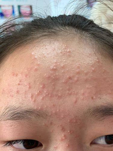 青少年痤疮(痘痘)能治吗?