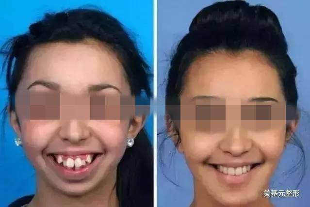 没了大龅牙,脸型也就没有那么前突了