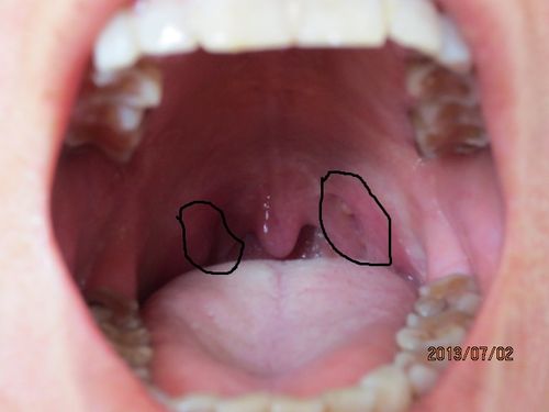 腭垂的右边长了个仡瘩是什么有图片吗