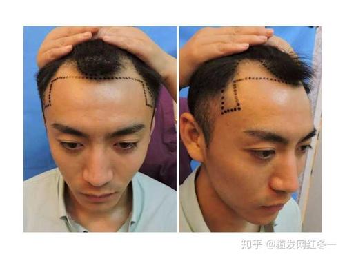 如果一定要做一个选择,发际线后移和秃顶你选哪一个?