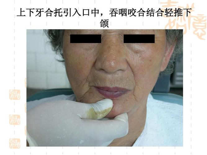 上下牙合托引入口中,吞咽咬合结合轻推下 颌