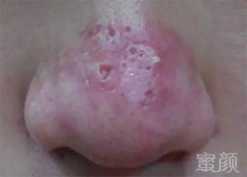 鼻子上经常长痘痘,是不是得了酒渣鼻?