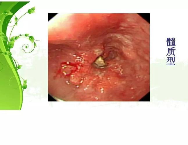 食管癌病人的护理