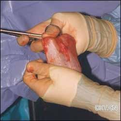 男人变女人 变性手术过程图示