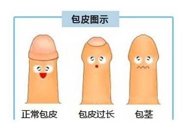 小孩割包茎可以报医保吗 深圳医保医院割包皮