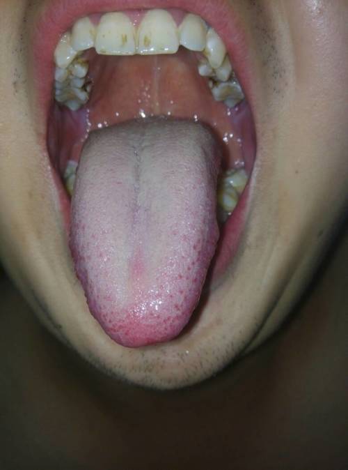 我的舌头是白白色念珠菌感染么?求专家,我口唇干,嘴里