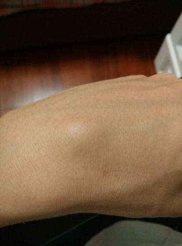 手背上有凸起硬硬的,医院看了也看不出什么说没事,后来好了,过一段