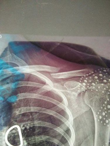 锁骨骨折,远端向内向下移位,上下分离,已经7周多,请问