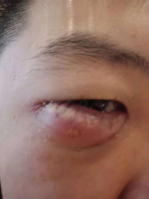 麦粒肿已经有七天了 之前没有热敷 后面开始热敷越敷肿的越来越大 像