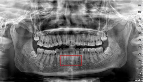 牙根短可以正畸吗?