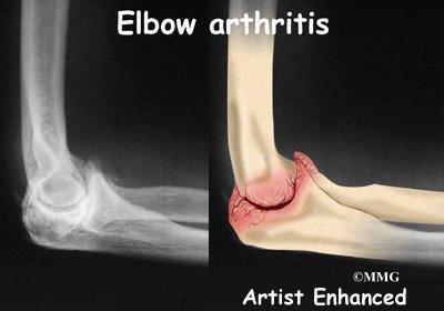 胳膊肘旋转,屈伸越来越困难,五指没劲,筷子用不了,是什么疾病