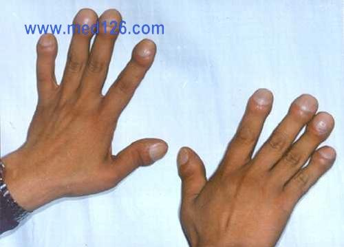 肢端肥大症的临床表现