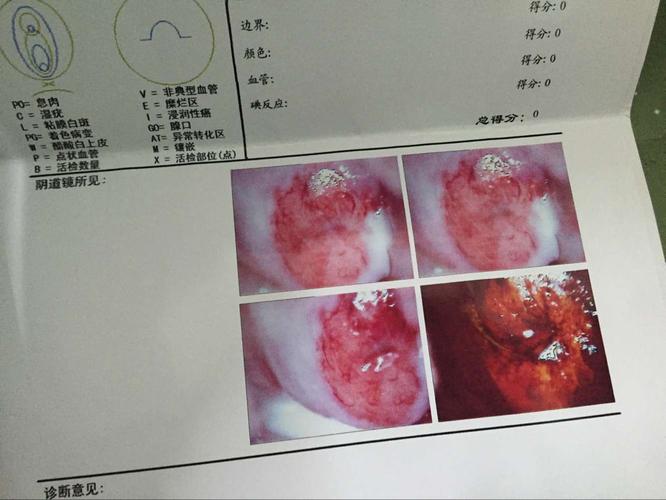 请医生帮我看一下,医院说是宫颈糜烂中度 让做激光 该