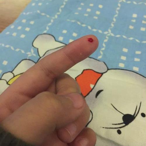 被仓鼠咬了怎么办