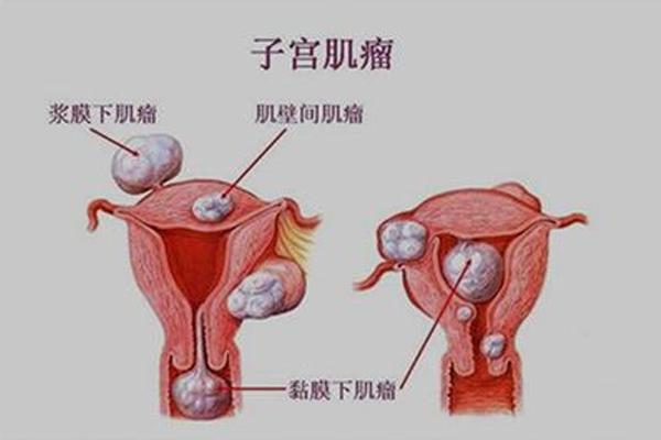 原创17岁子宫肌瘤4cm,医生:若瘤体存在3种状态,及时手术,马虎不得
