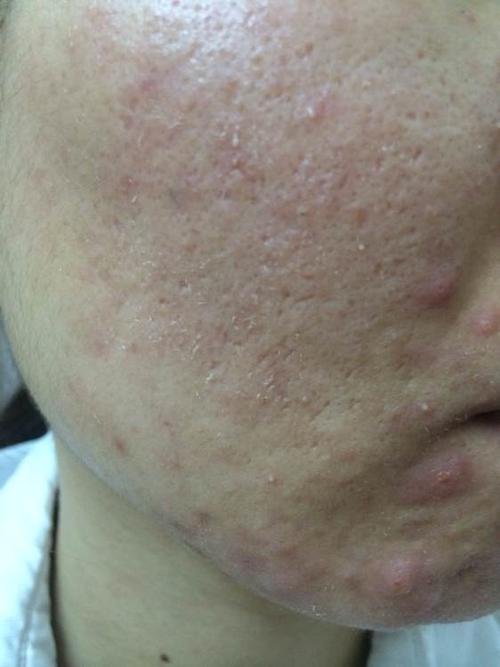 皮肤有这些症状,可能脂溢性皮炎与你结缘了!