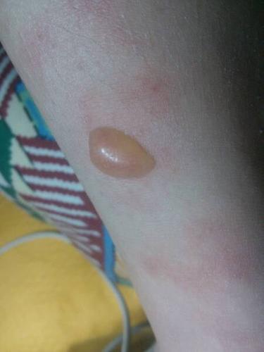 腿上红斑,长了水泡