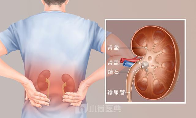 肾结石的典型症状以疼痛为主,疼痛的部位多为腰腹部,查体可见肾区的叩