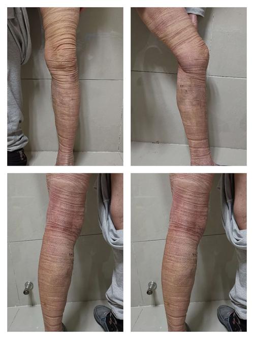 赵德玉,11月30日复查,左下肢对化纤过敏