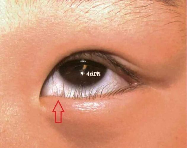 宝宝睫毛倒长怎么办01_睫毛_长睫毛_眼药水_保护角膜_人工泪液_异物
