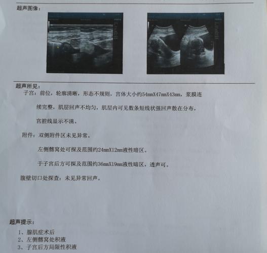 和"不死的癌症"——子宫腺肌症说"拜拜"