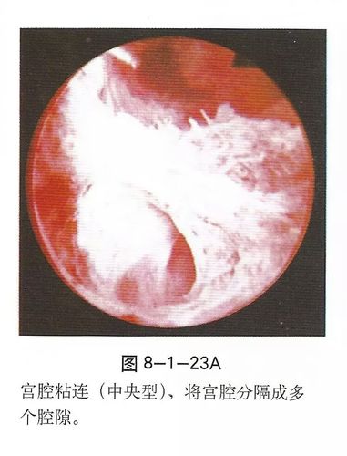 宫腔黏连是什么样的?