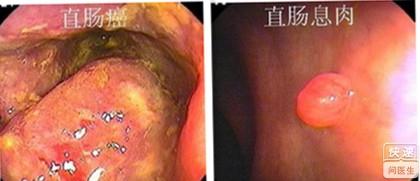 直肠癌与直肠息肉分别有什么症状