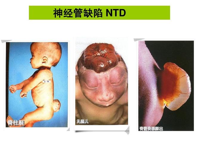 神经管缺陷 ntd