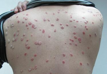 青年脓疱型牛皮癣物理治疗