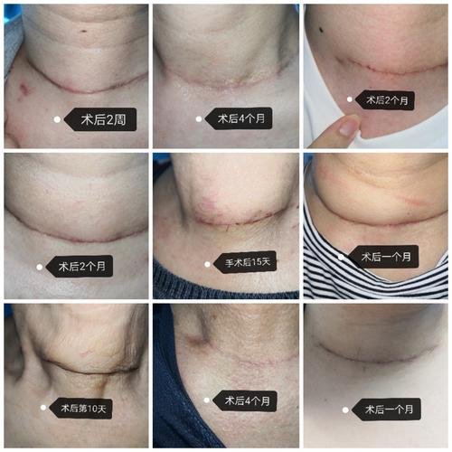 聊聊甲状腺手术后伤口管理那点事图文