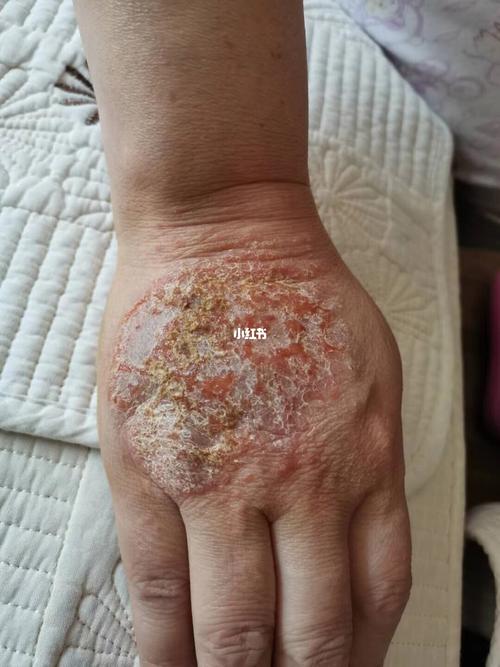 慢性湿疹,感染溃烂.皮肤给你恢复到原样