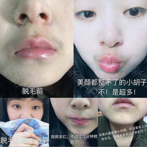 激光脱毛