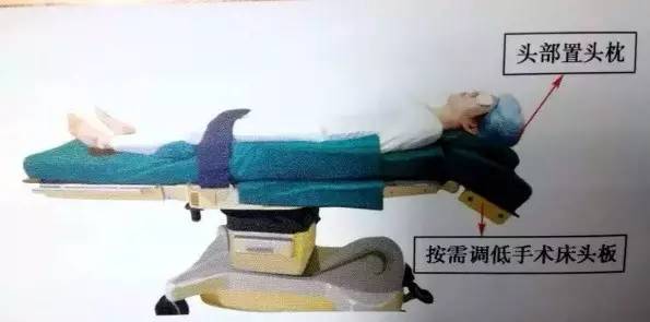 仰卧位摆放流程及注意事项——2017版手术室护理实践指南