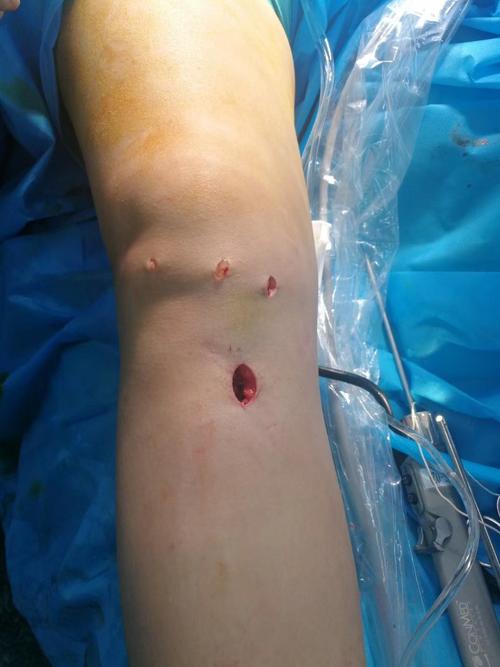 膝关节前交叉韧带重建,我们的微创手术怎么做的?