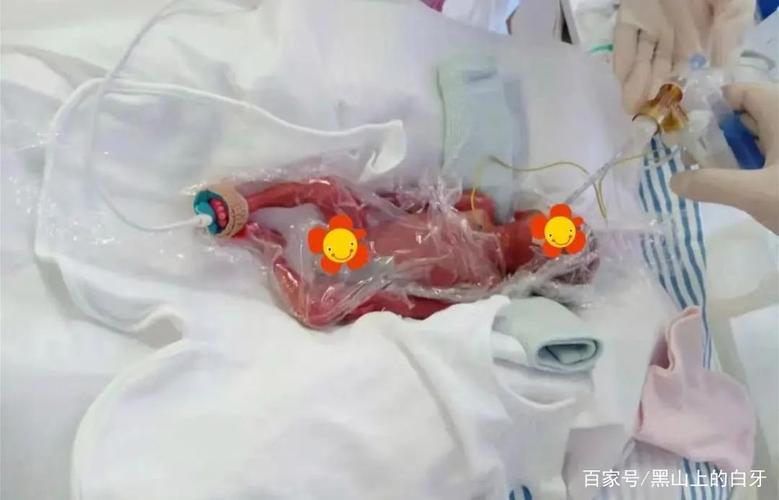经过112个日夜的救治22周胎龄出生仅495克的大力宝宝回家了