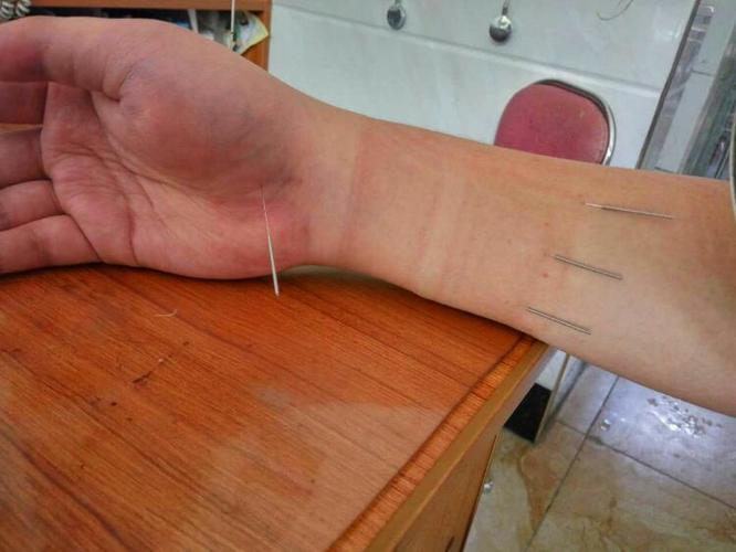 因为拇指,食指,中指和手腕还是不能动,医生给我刺激手腕和手指的针灸