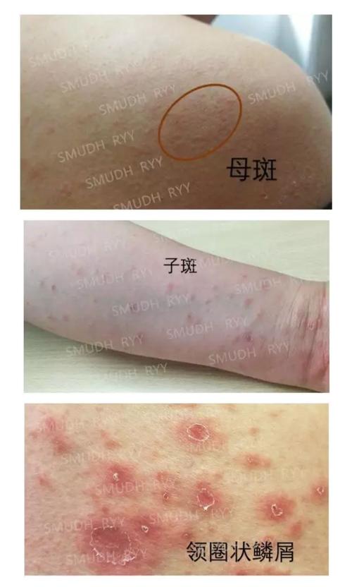【健康教育】玫瑰糠疹:开在身上的"一树繁花"