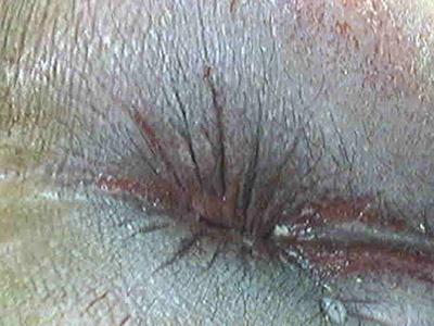 肛门湿疹的判断标准肛门湿疹根据病史,病程,形态上具备多形性弥漫性