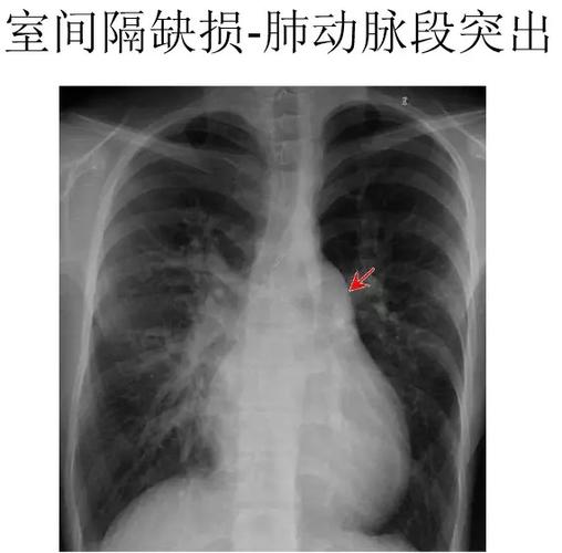 心脏x线表现