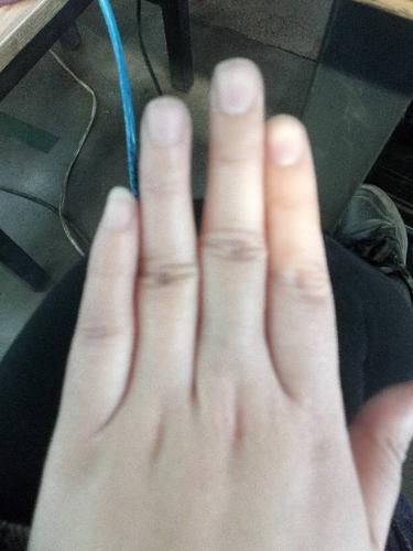 我的左右手无名指和中指有特别大的缝隙,并拢不了,是怎么回事