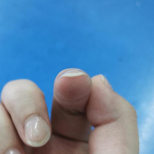 指甲向下抠很严重,是什么问题呢?(图片有更新)