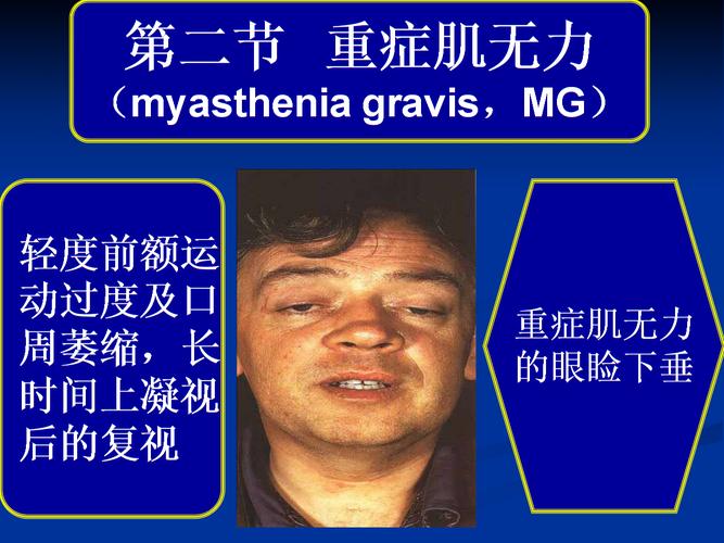 常见疾病病因与治疗方法重症肌无力课件.ppt
