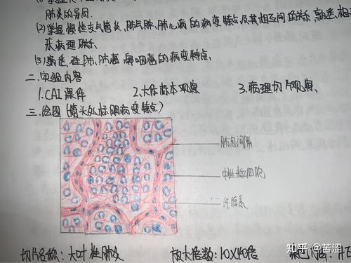 图七,门脉性肝硬化