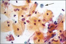 阴道毛滴虫(trichomonas vaginalis, donne 1837)是寄生在人体阴道和